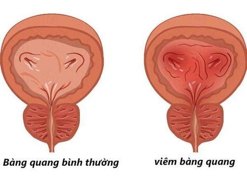 small_20191018_143437_921076_viem_bang_quang_max_1800x1800_jpg_553dfa5e8b.jpg